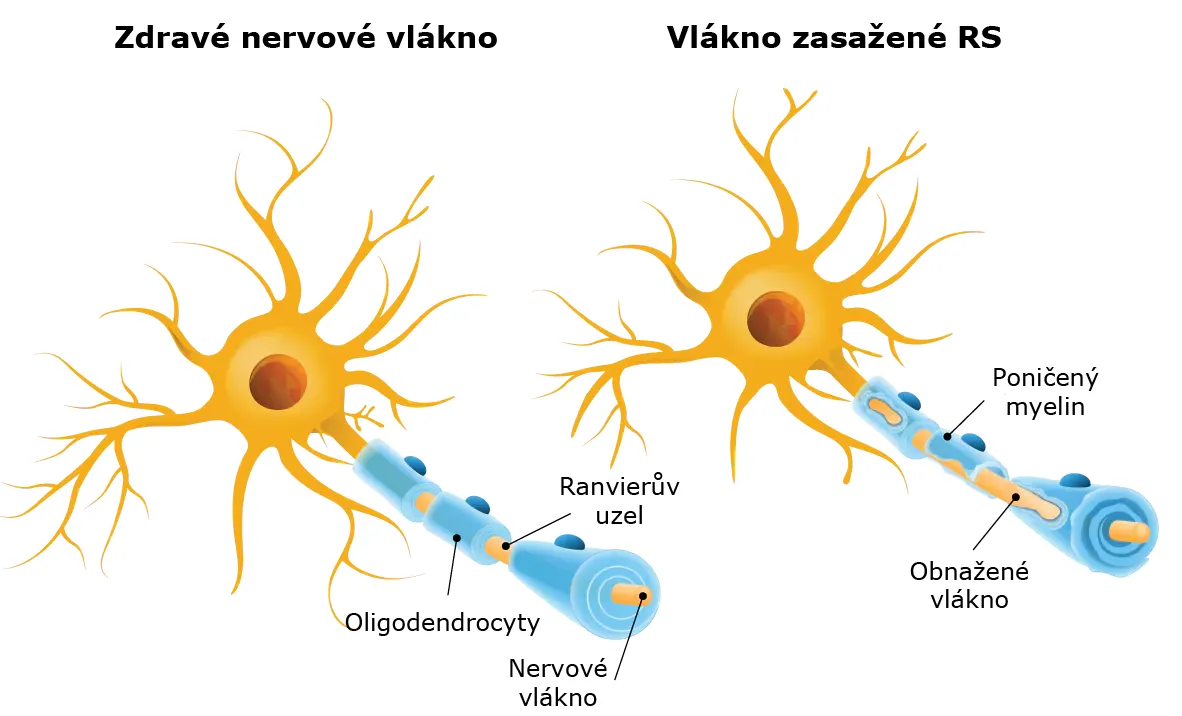 Roztroušená skleroza a její tváře